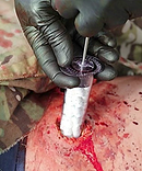 Карманный шприц для остановки крови из огнестрельного ранения 